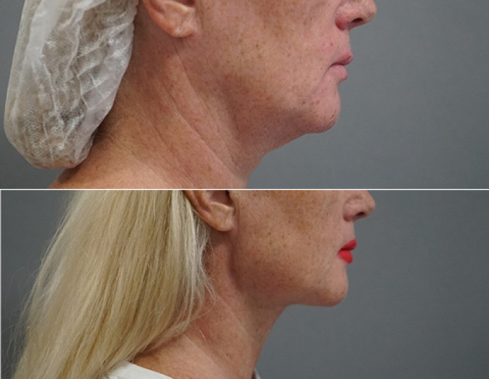 Пациентка хирурга Арслана Пенаева до и после мкльтитехнологичного лифитнга лица