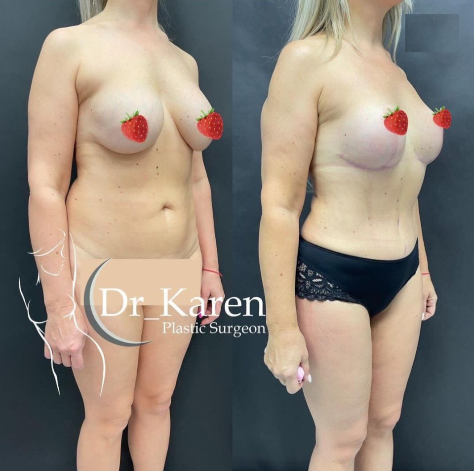 Пациентка пластического хирурга Карена Пайтяна. Фото до и после комплексной операции по проекту «Постнатал».