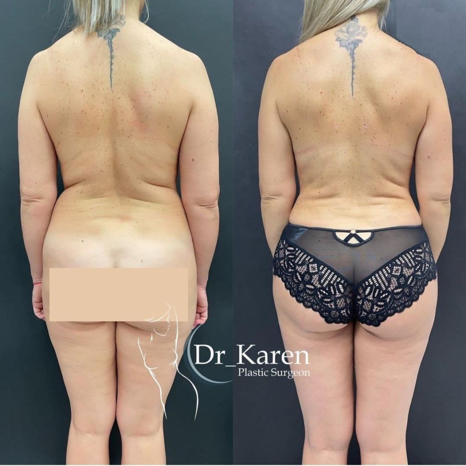 Пациентка пластического хирурга Карена Пайтяна. Фото до и после комплексной пластической операции по проекту «Постнатал».