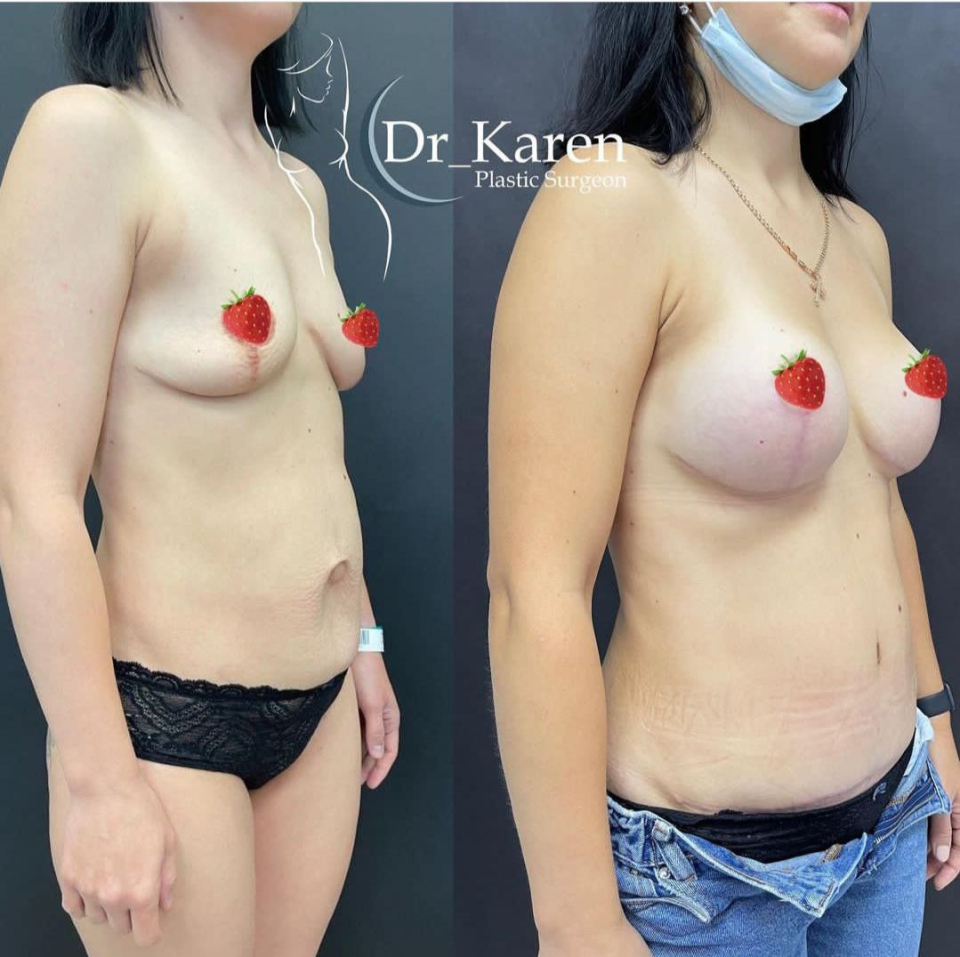 Пациентка пластического хирурга Карена Пайтяна. Фото до и после комплексного послеродового восстановления «Постнатал»