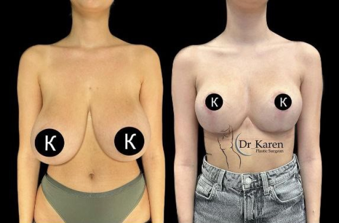 Пациентка доктора Карена Пайтяна до и после редукционной маммопластики.