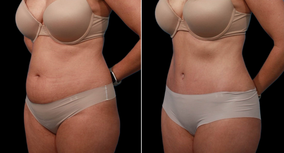 Пациентка доктора Гукаса Миракяна до и после подтяжки живота