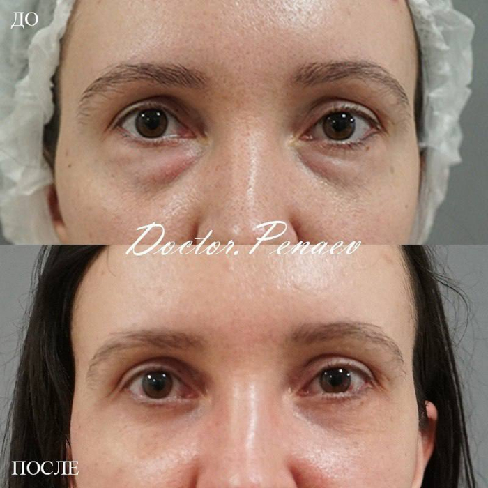 Пациентка доктора Арслана Пенаева до и после трансконъюнктивальной пластики век