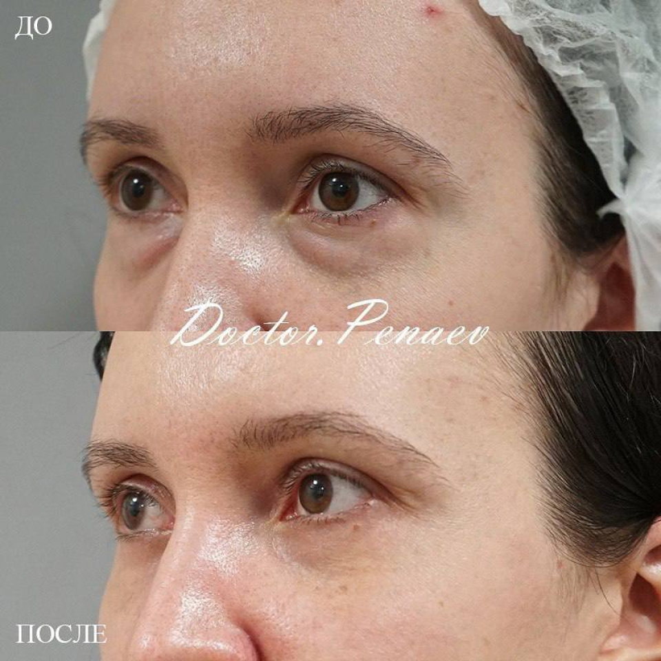 Пациентка хирурга Арслана Пенаева до и после трансконъюнктивальной блефаропластики и шлифовки кожи СО2-лазером Ultra Pulse