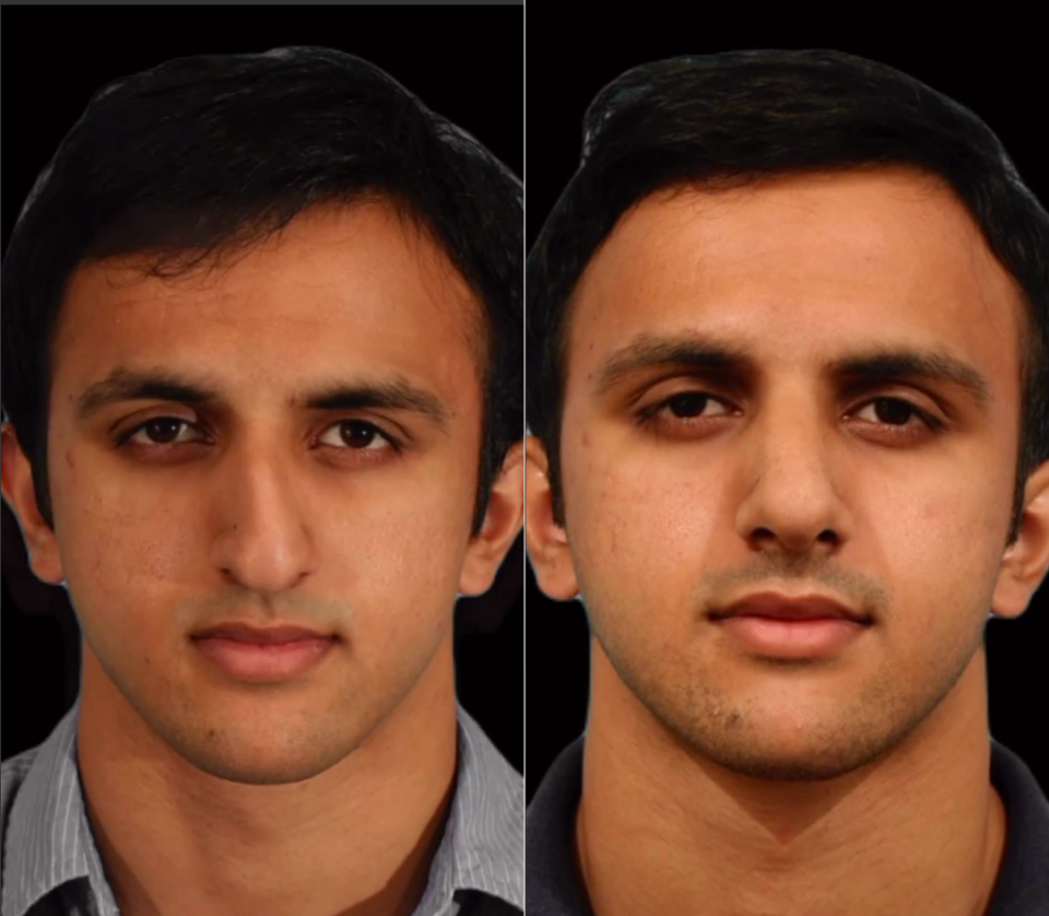 Пациент пластического хирурга Гукаса Миракяна до и после ринопластики