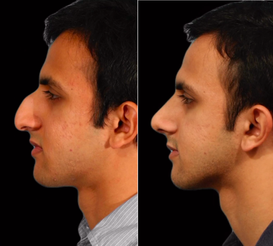 Пациент пластического хирурга Гукаса Миракяна до и после ринопластики в Москве
