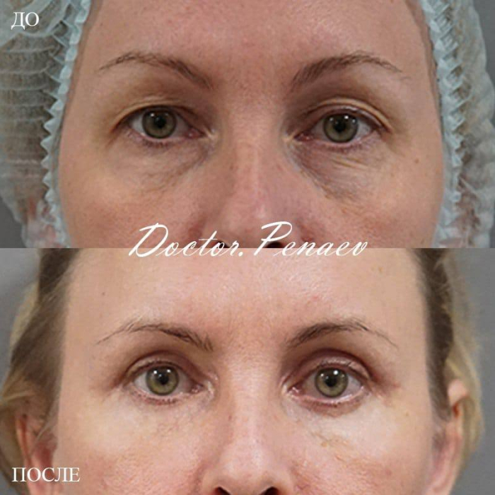 Пациентка доктора Арслана Пенаева до и после круговой пластики век