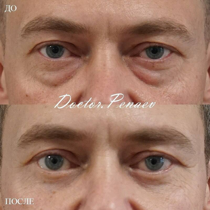 Пациент доктора Пенаева до и после блефаропластики нижних век