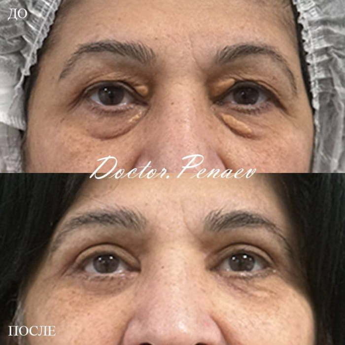 Пациентка доктора Арслана Пенаева до и после круговой пластики век и кантопексии