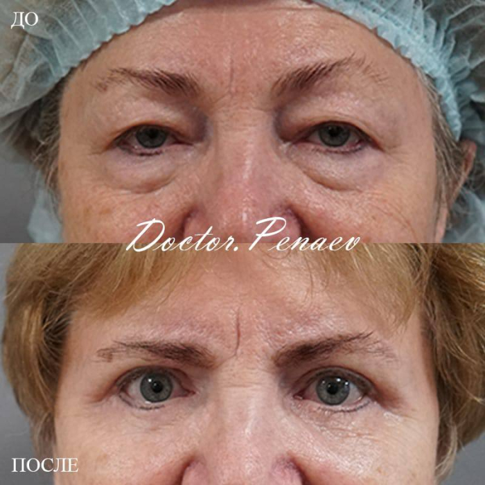 Пациентка доктора Пенаева. Была выполнена блефаропластика верхних и нижних век