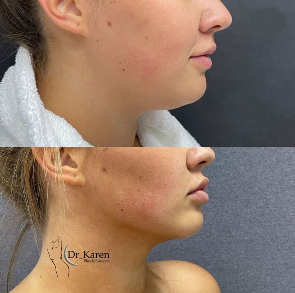 Пациентка доктора Карена Пайтяна до и после коррекции овала лица