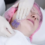 Нитевой лифтинг лучше, чем Ботокс?