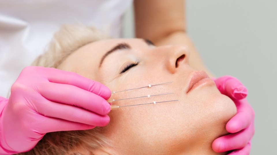 Нитевой лифтинг