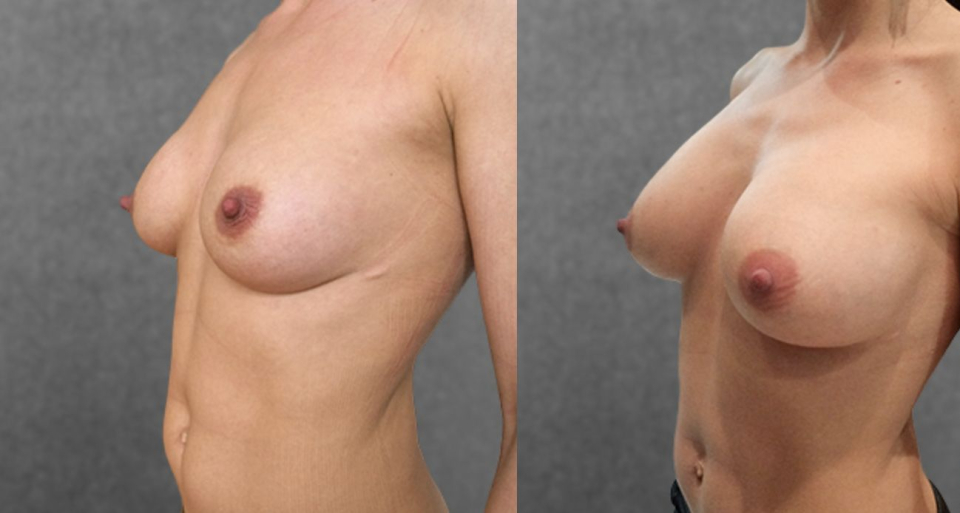 Пациентка пластического хирурга Дмитрия Крысина до и после увеличения груди имплантами