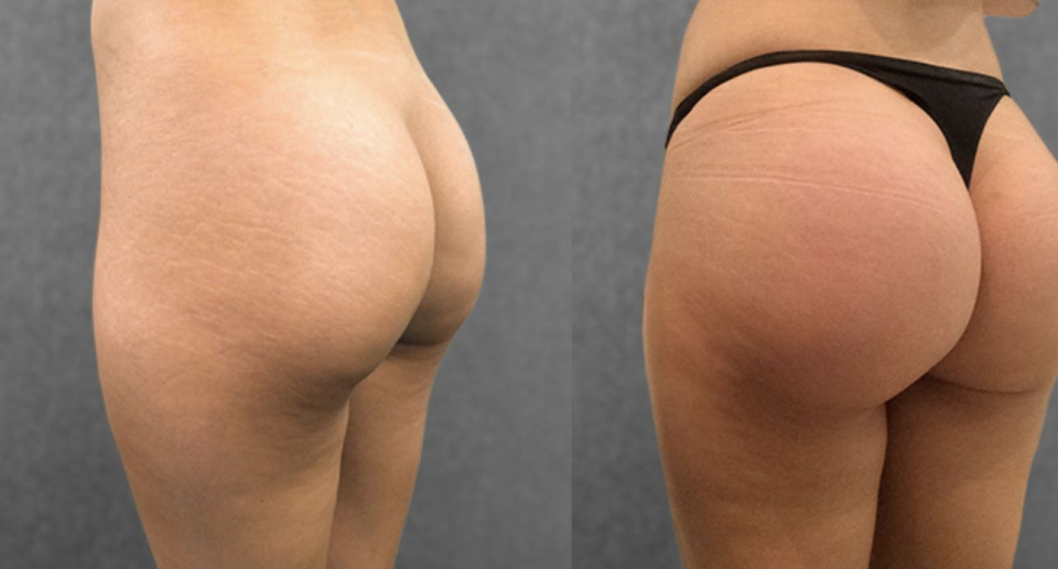 Пациентка пластического хирурга Дмитрия Крысина до и после глютеопластики — увеличения ягодиц имплантами