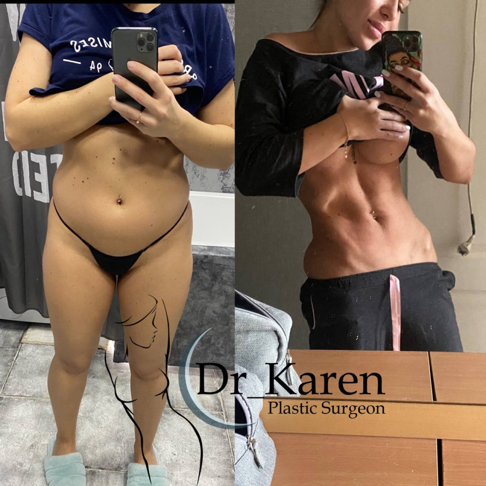 Пациентка доктора Карена Пайтяна до и после липомоделирования тела