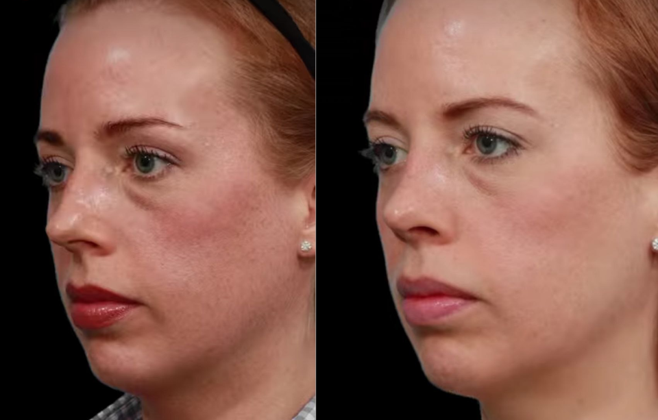 Пациентка пластического хирурга Гукаса Миракяна до и после риносептопластики