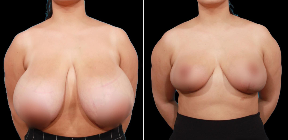 Пациентка пластического хирурга Гукаса Миракяна после редукции груди