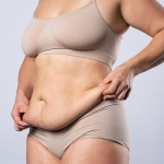 50 лет – слишком поздно для подтяжки живота