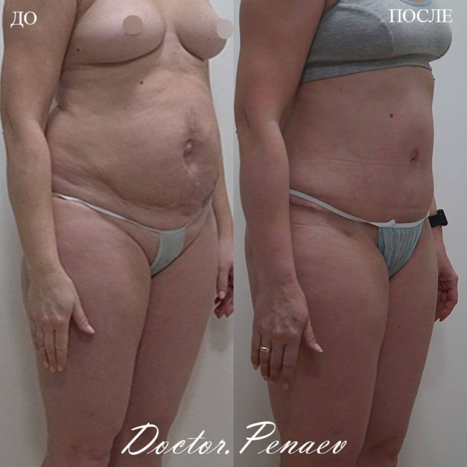 Пациентка доктора Арслана Пенаева до и после Vaser липоабдоминопластики