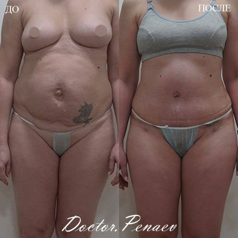 Пациентка доктора Арслана Пенаева до и после комплексной коррекции тела, включая абдоминопластику