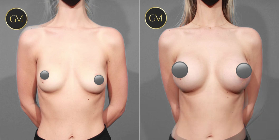 Пациентка доктора Гукаса Миракяна до и после увеличивающей маммопластики
