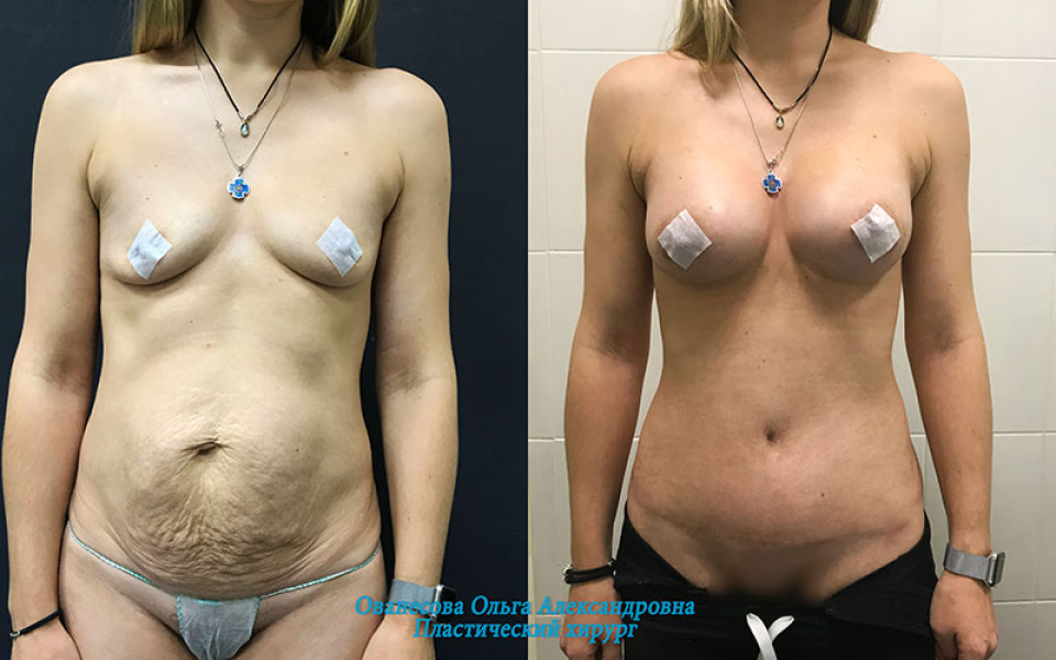 Пациентка пластического хирурга Ольги Ованесовой. Женщина обратилась с запросом на послеродовое восстановление фигуры