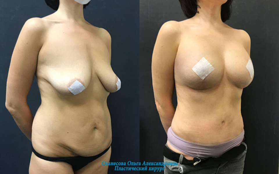 Пациентка пластического хирурга О. Ованесовой. Женщине было проведено послеродовое восстановление фигуры