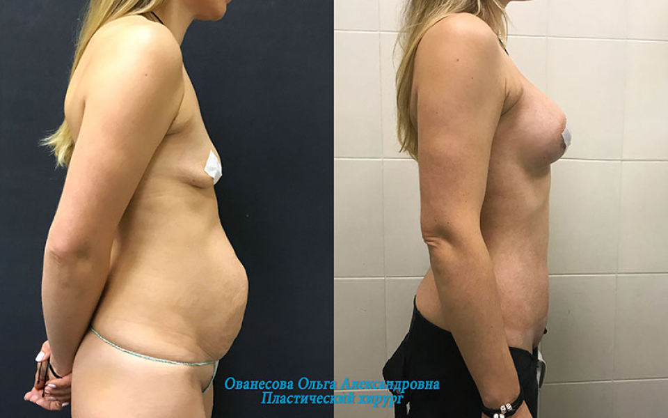 Пациентка пластического хирурга Ольги Ованесовой. Женщина обратилась с запросом на послеродовое восстановление фигуры