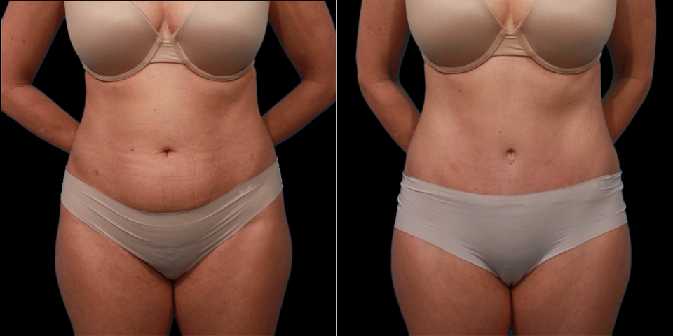 Пациентка пластического хирурга Гукаса Миракяна. Фотография до и после абдоминопластики
