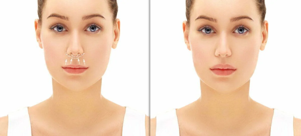 Подтяжка губ Булхорн