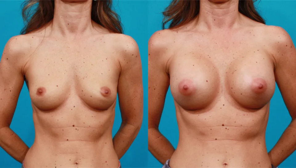 Пациентка доктора Гукаса Миракяна до и после увеличения груди имплантами
