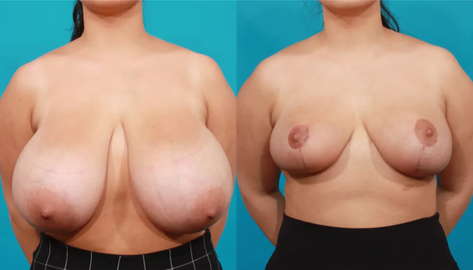 Пациентка доктора Гукаса Миракяна до и после уменьшения груди