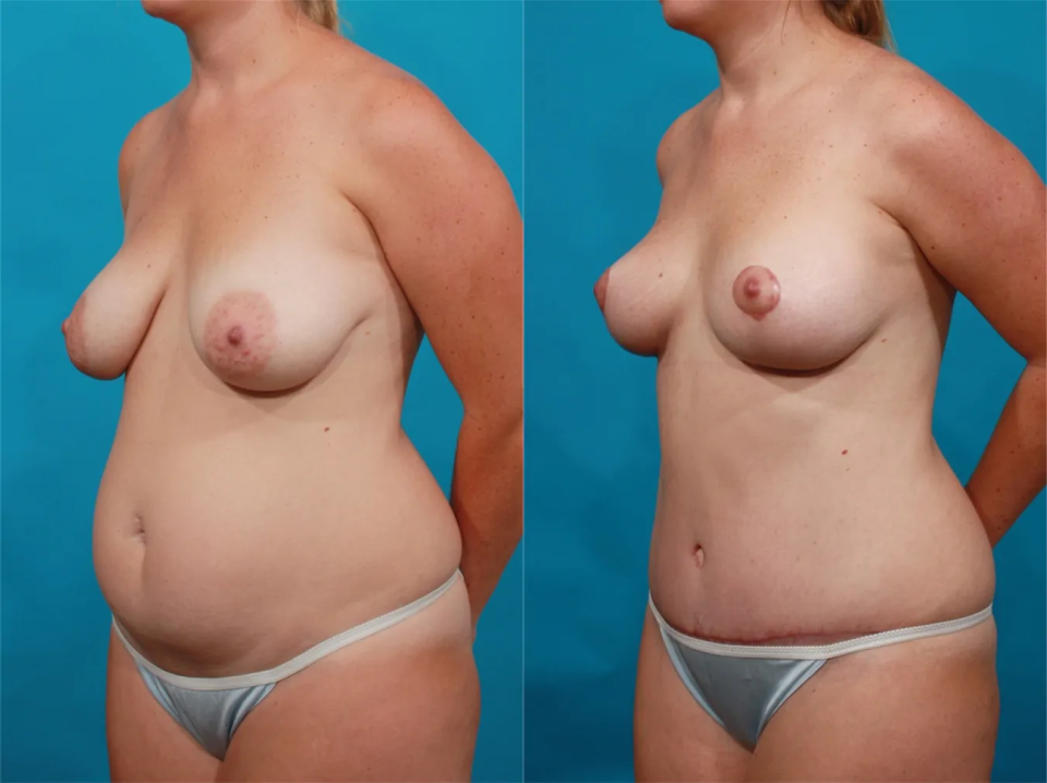 Пациентка доктора Гукаса Миракяна до и после мастопексии