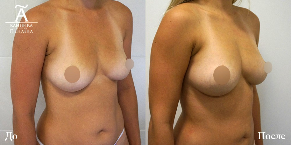 Пациентка (30 лет) профессора Пенаева до и после липофилинга груди
