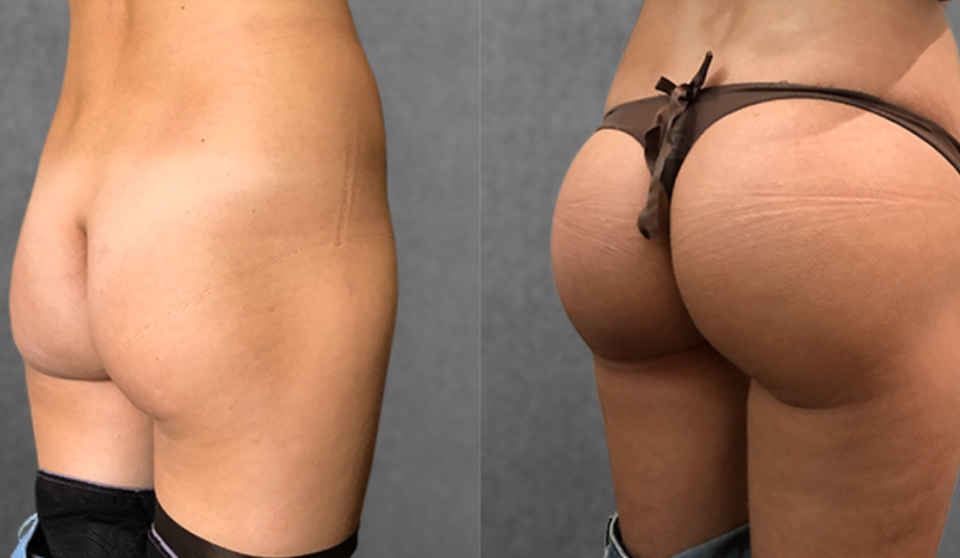 Пациентка пластического хирурга Дмитрия Крысина. Фото до и после увеличения ягодиц имплантами