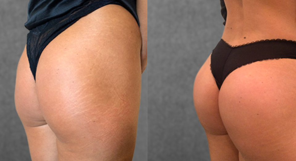 Пациентка пластического хирурга Дмитрия Крысина. Фото до и после глютеопластики