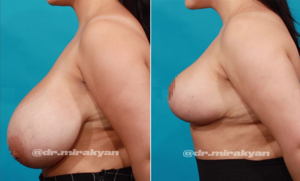 Пациентка доктора Миракяна до и после операции по уменьшению груди