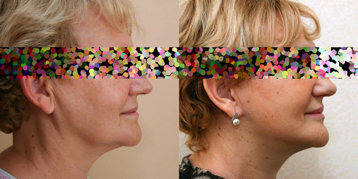 Пациентка доктора А. Жукова до и после подтяжки лица