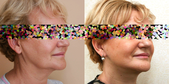 Пациентка доктора А. Жукова до и после подтяжки лица