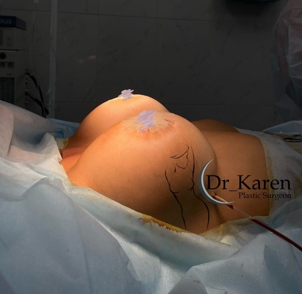 Пациентка доктора Карена Пайтяна. Выполнено увеличение груди с подтяжкой вокруг ареол