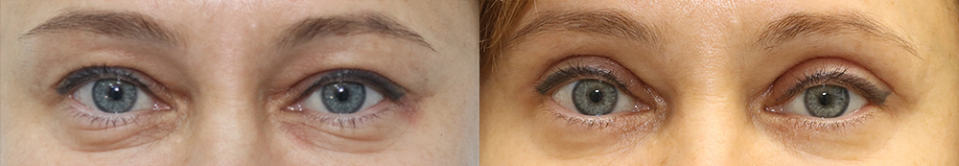 Пациентка пластического хирурга Александра Жукова до и после блефаропластики.