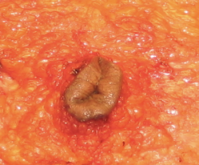 У большинства пациентов пупок остается прикрепленным к брюшной стенке