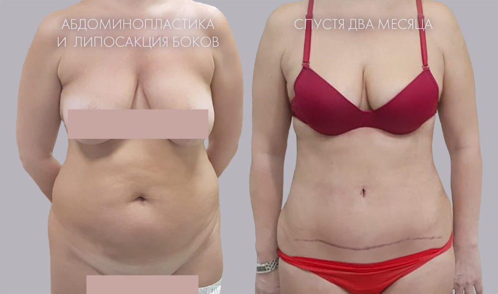 Пациентка доктора Панаетова. Фото до и после комплексной операции – абдоминопластики и липосакции