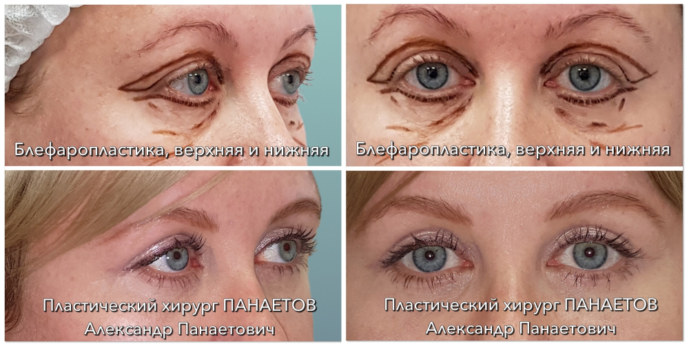 Пациентка доктора Панаетова. Фото до и после круговой блефаропластики