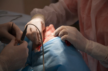 Блефаропластика у доктора Панаетова