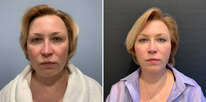 Пациентка хирурга Александра Каткова до и после спейслифтинга лица