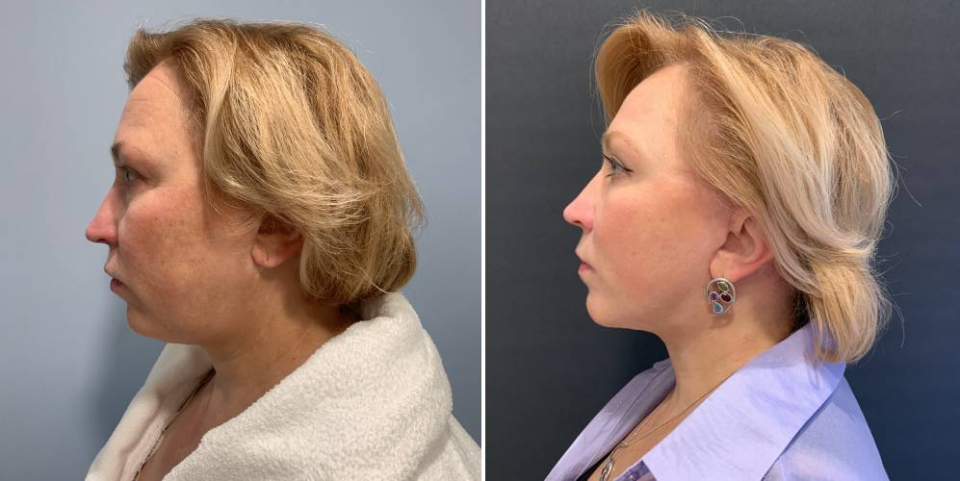 Спейслифтинг Александр Катков