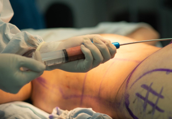 Мифы и советы о предотвращении жирового некроза после липофилинга ягодиц