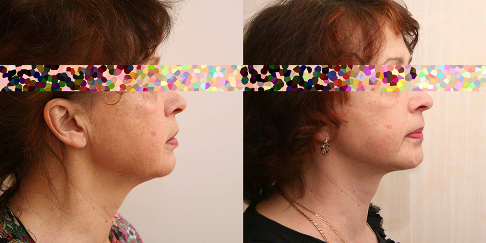 Пациентка пластического хирурга Александра Жукова на фото до и после подтяжки лица